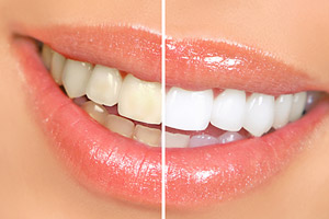 Teeth Whitening | Mark Massaro DDS | Tulsa OK Dentist